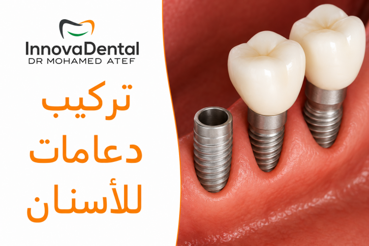 تركيب دعامات للاسنان لابتسامة طبيعية وجذابة